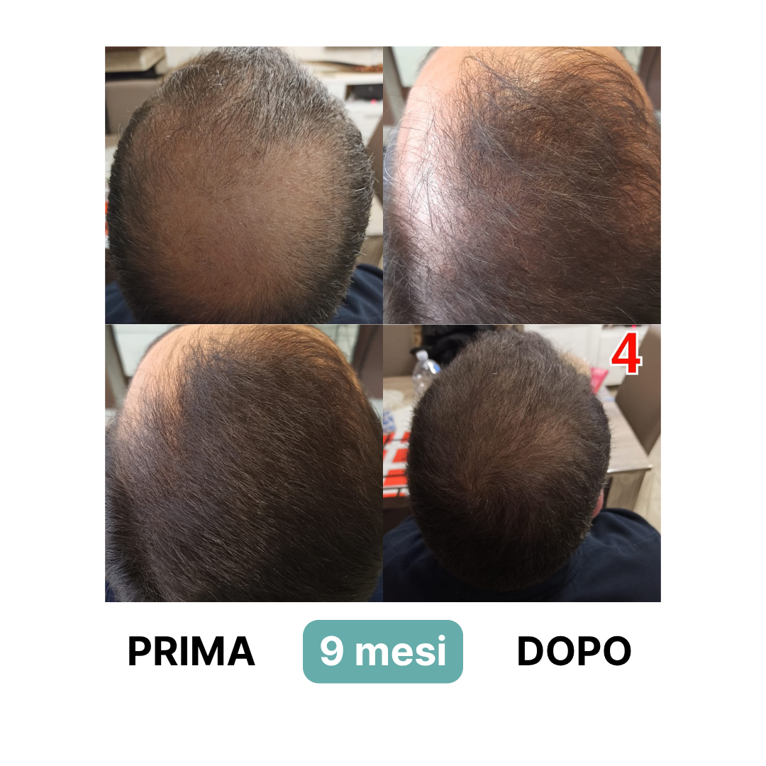 Routine a base di Cellule Staminali Naturali per capelli fragili e diradati | Trattamento Avanzato con Shampoo + Lozione