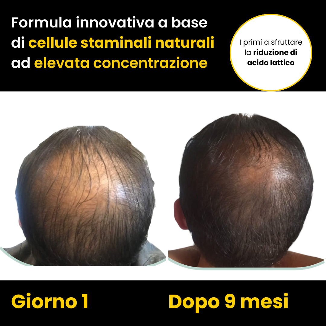 Routine a base di Cellule Staminali Naturali per capelli fragili e diradati | Trattamento Avanzato con Shampoo + Lozione