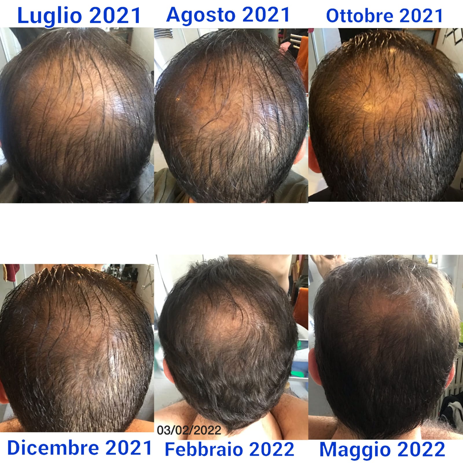BUNDLE TOP: Routine a base di Cellule Staminali Naturali per capelli fragili e diradati | Trattamento Avanzato con Shampoo + Lozione