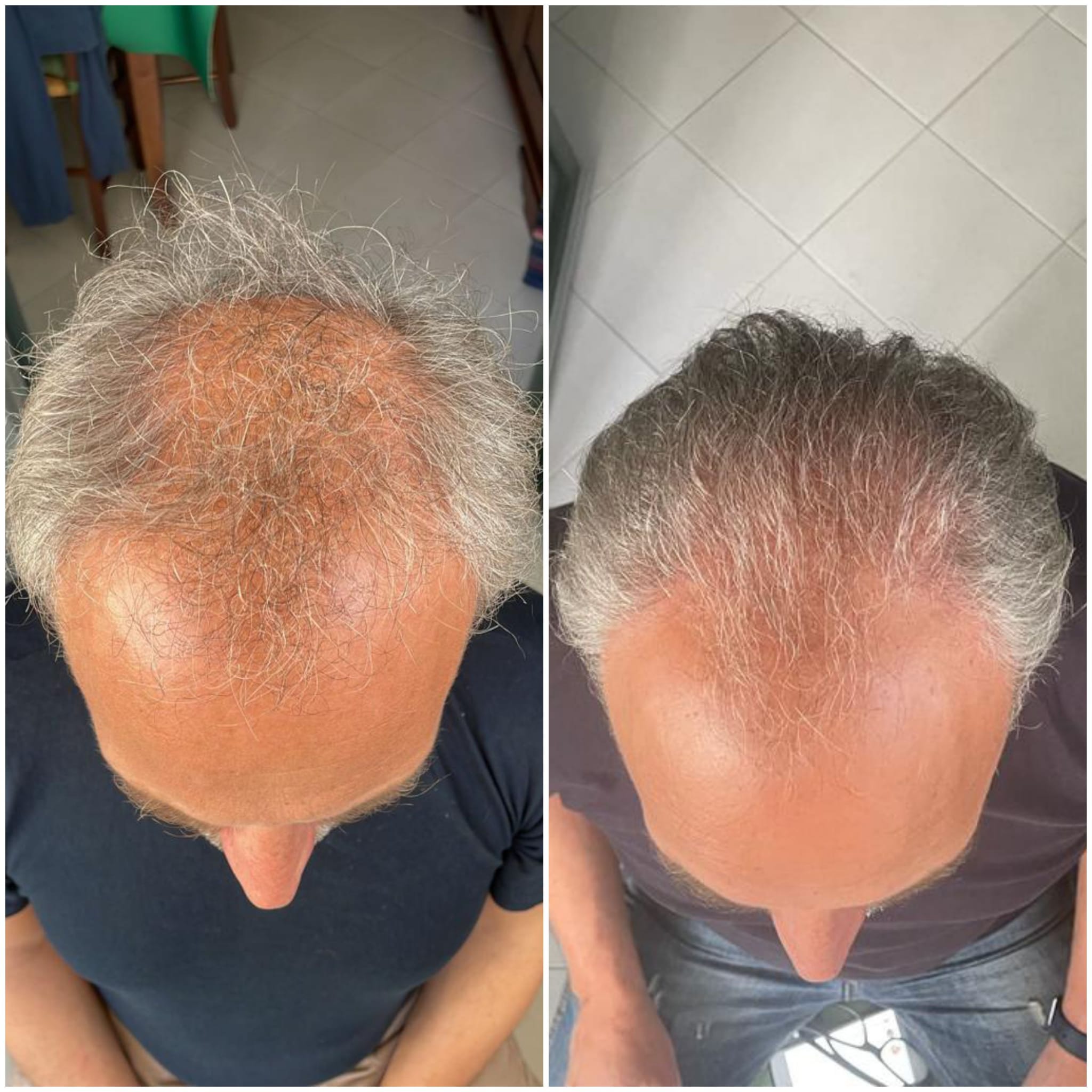 TRICOMPLEX - Integratore Capelli Densificante alla Mela Annurca: Stimola la Crescita, Rinforza il Fusto e Nutre il Bulbo