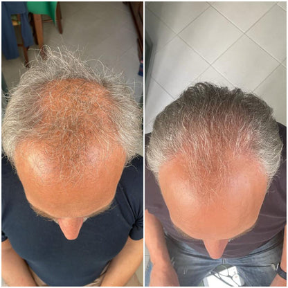 Routine a base di Cellule Staminali Naturali per capelli fragili e diradati | Trattamento Avanzato con Shampoo + Lozione